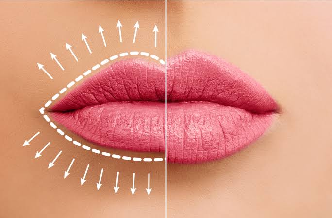 Lip flip procedure